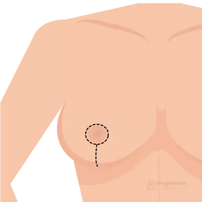 Lifting-des-seins-DR-Hatem-Zili-verticale-v2-cet-0b467cda Lifting des seins