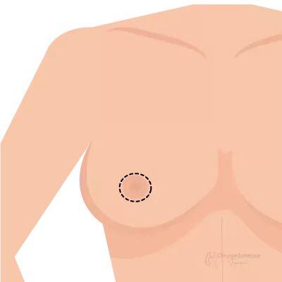Lifting-des-seins-DR-Hatem-Zili-round-bloc-v2-cet-3fbc53f6 Lifting des seins