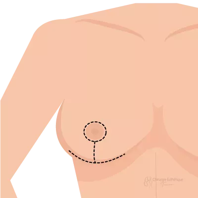 Lifting-des-seins-DR-Hatem-Zili-T-inverse-v2-cet-7bb5cb6c Lifting des seins