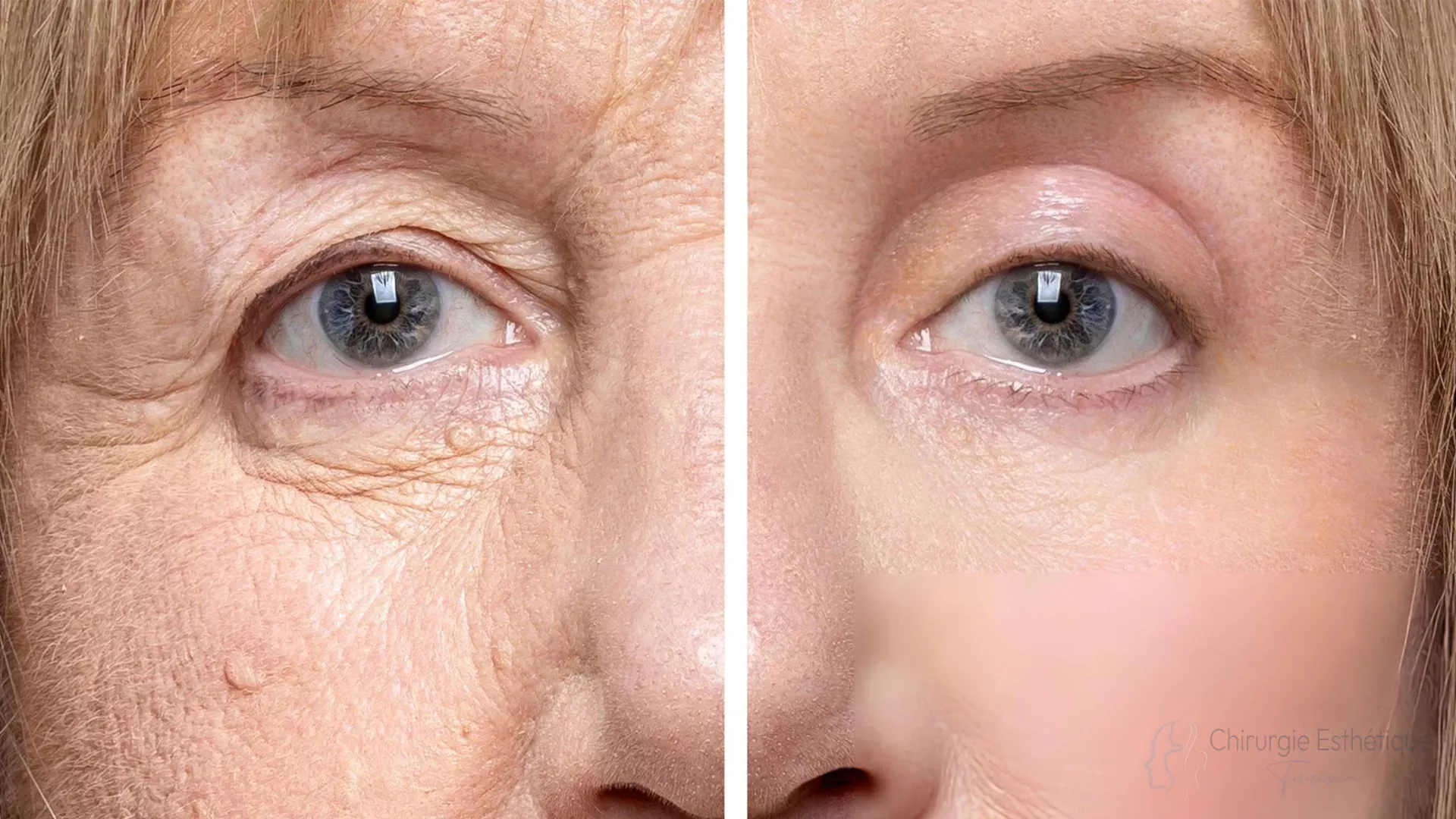 Blépharoplastie Avant Après