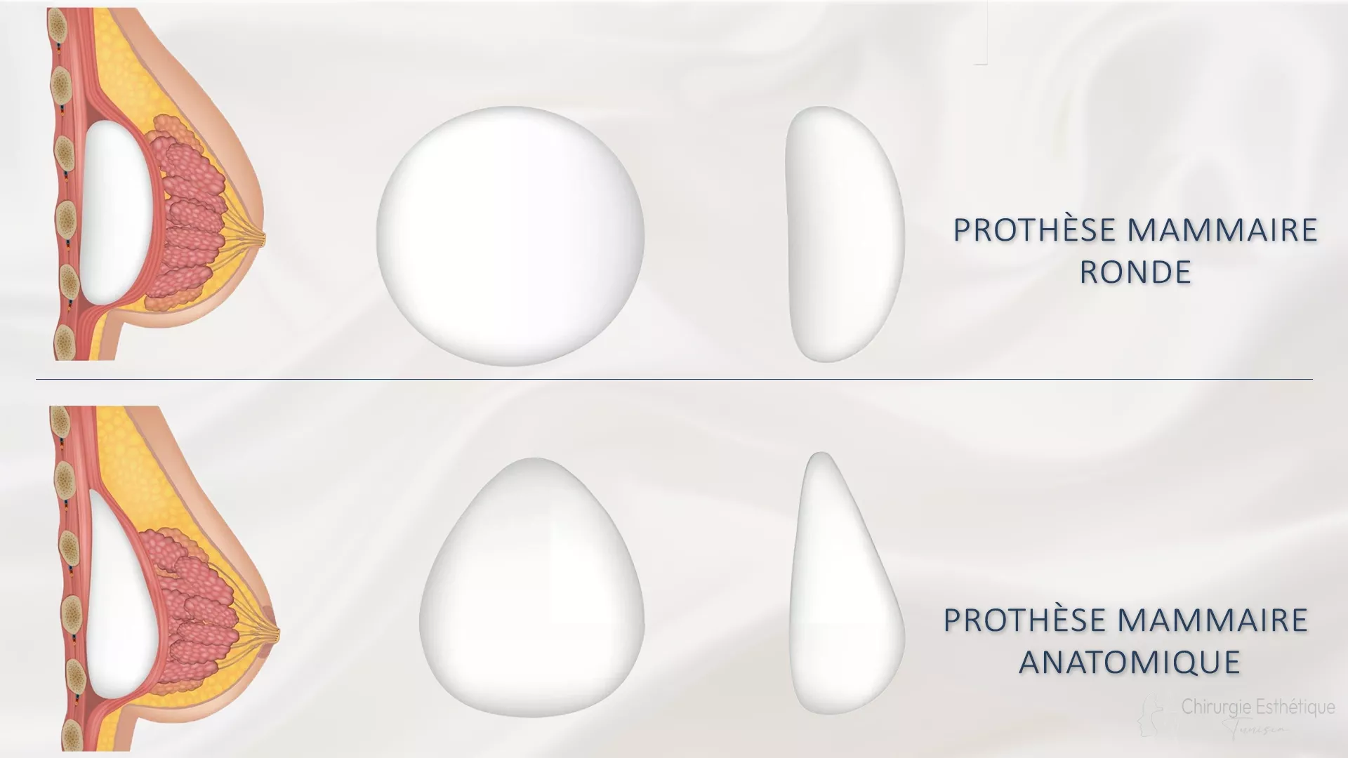 Formes des prothèses mammaires